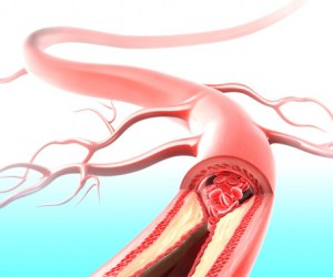 Deep Vein Thrombosis