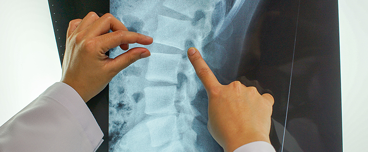 Memphis Spinal Cord Injury Lawyers