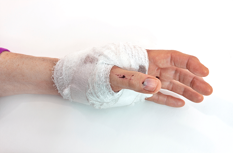Bandaged hand with visible dog bite injury, illustrating the type of injuries Memphis delivery drivers commonly sustain from on-the-job dog attacks.